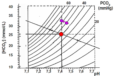 alcalose métabolique.png