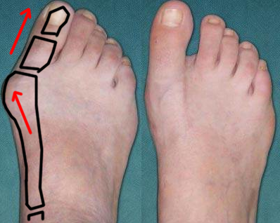 Hallux valgus.png
