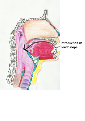 introduction de l'endoscope.png