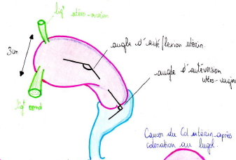angle antéversion.png