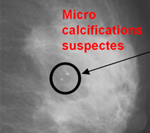 microcalcifications.PNG