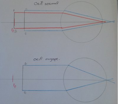 punctum proximum myope.jpg