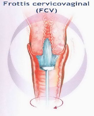 frottis cervicovaginal.jpg