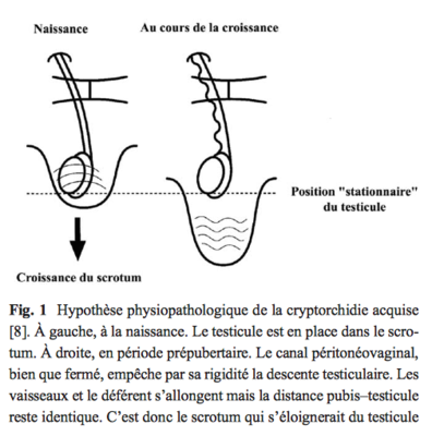 cryptorchidie acquise.png