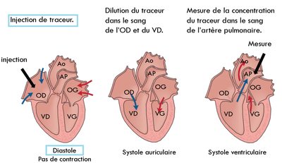 traceur en diastole.png