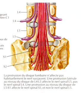 hernie discale .png