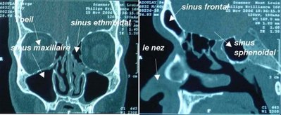 anatomie-et-fonctions-du-nez-les-sinus-de-la-face-161-660x660-1.jpg
