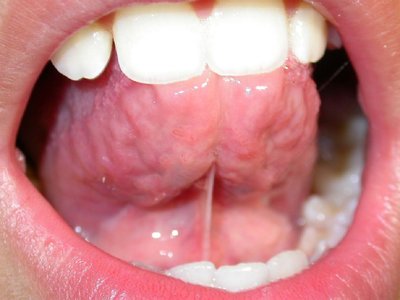 frein de la langue.jpg