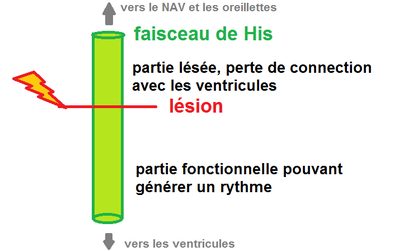 lésion His.png