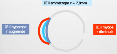 Amétropies de courbure.PNG