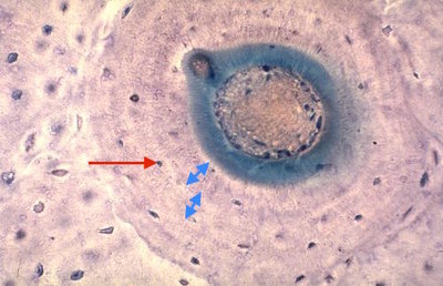 ostéon très avancé étape 4.jpg