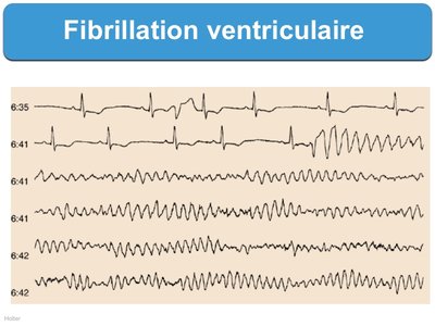 fibrillationventriculaire1.jpg
