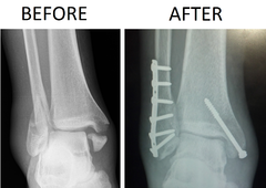 240px-Trimalleolar_Ankle_Fracture_Xray_shown_before_surgery_and_after_surgery.png