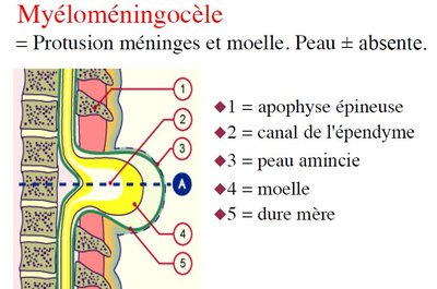 Myéloméningocèle.jpg