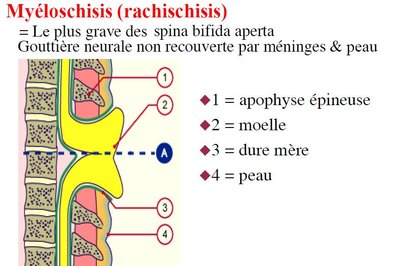 Rachischisis.jpg