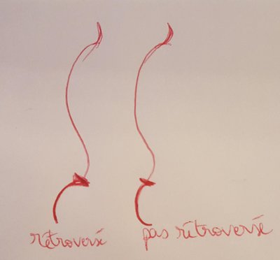 sacrum rétroversé.jpg