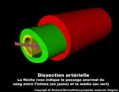 dissection-arterielle.jpg