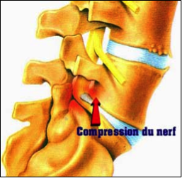 hernie-discale-L5S1-comprimant-nerf-sciatique.png