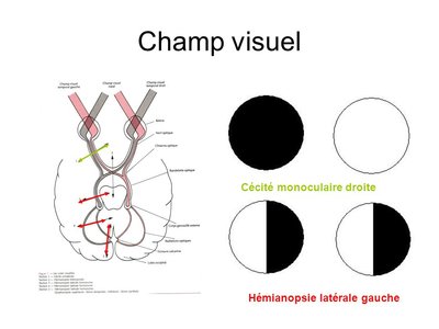 Champ+visuel+Cécité+monoculaire+droite+Hémianopsie+latérale+gauche.jpg