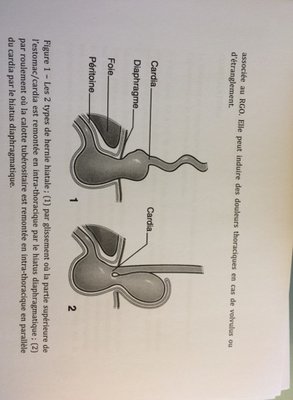 hernies hiatales.jpg