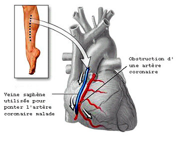 pontage-veine-saphene.jpg