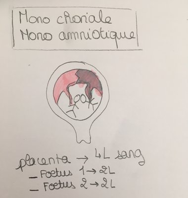 mono amniotique.jpg (958.87 Kio) Vu 526 fois mono amniotique.jpg
