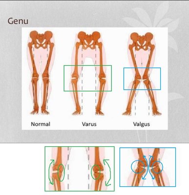 varus valgus.jpg