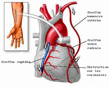 pontage-artere-radiale.jpg
