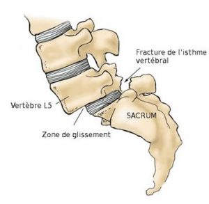 spondyloisthesis-lyse-isthmique.jpg