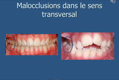 malocclusion image2.PNG