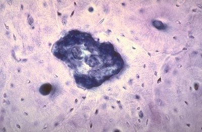 cavité de résorption.jpg