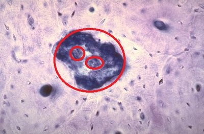 cavité de résorption.jpg