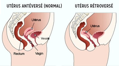 uterus-retroverse.jpeg