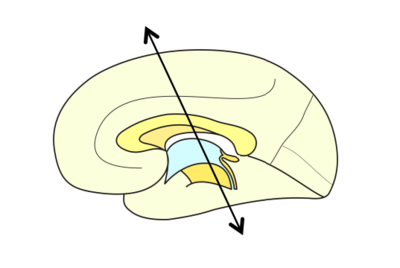 Plan de coupe de charcot .png