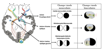 recap vision patho.PNG