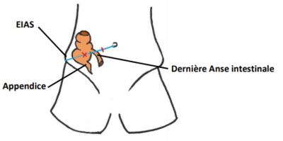 point de MacBurney.png