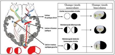 Capture hémianopsie latérale homonyme gauche.jpg