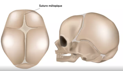 suture métopique.png