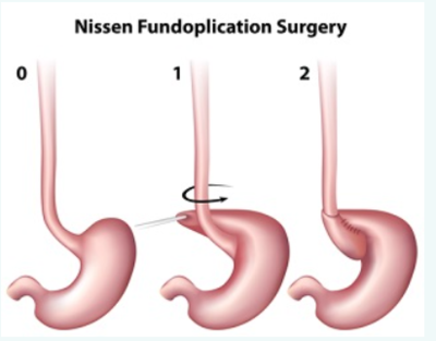 opération nissen et rosseti .png