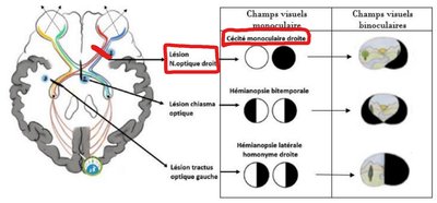 Section nerf optique droit.jpg