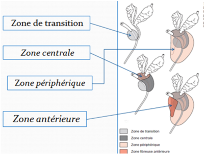 schéma prostat ecentrale et perif.png