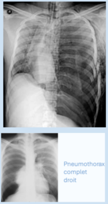 pneumothorax droit.png