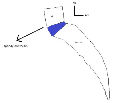 Spondylolisthesis chef-d'oeuvre.jpg