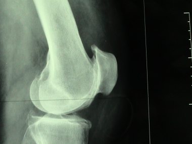 arthrose du genou .jpg
